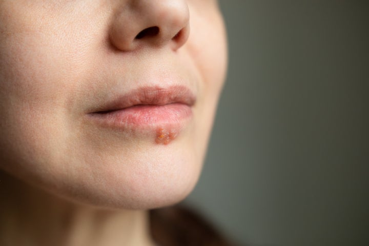 why-are-cold-sores-more-common-in-winter-and-how-do-you-tackle-them