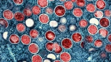  WHO Renames Monkeypox As Mpox, Citing Racism Concerns