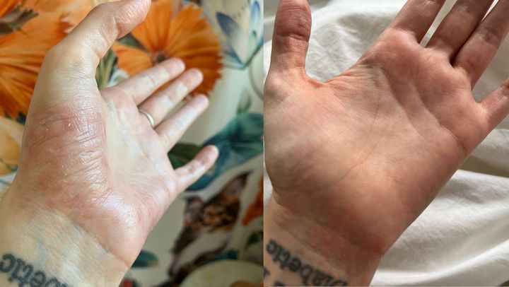 Left: A moderate eczema flare-up with red, flaky patches. Right: After about three weeks of regularly applying the daily defense cream and quick relief treatment for bouts of itching.