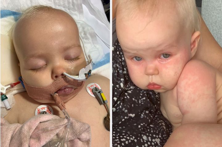 Bella Hessey developed a rash across her body and was later diagnosed with Kawasaki disease.
