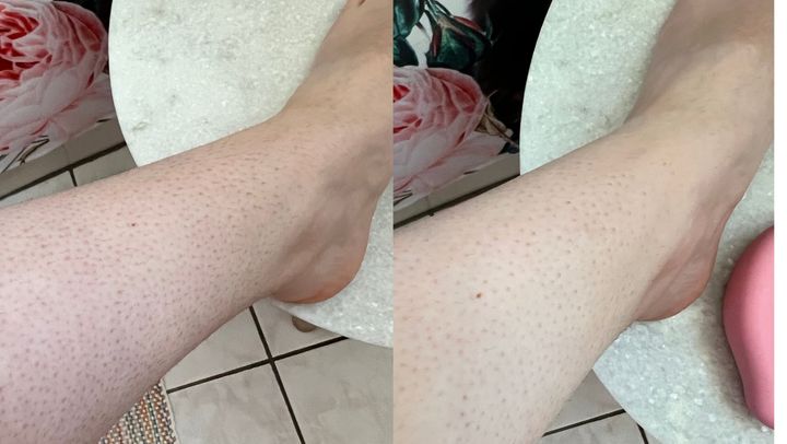 Left: Four days of leg hair growth. Right: Immediately after using the crystal hair eraser on the middle section of shin. The skin looks brighter and the hair is gone.