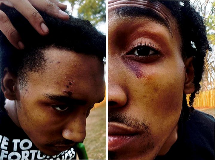 These photos of Monterrious Harris, 22, were taken nine days after he was discharged from a hospital following his Jan. 4 arrest, according to a federal lawsuit filed Tuesday against the city of Memphis and its five former officers.