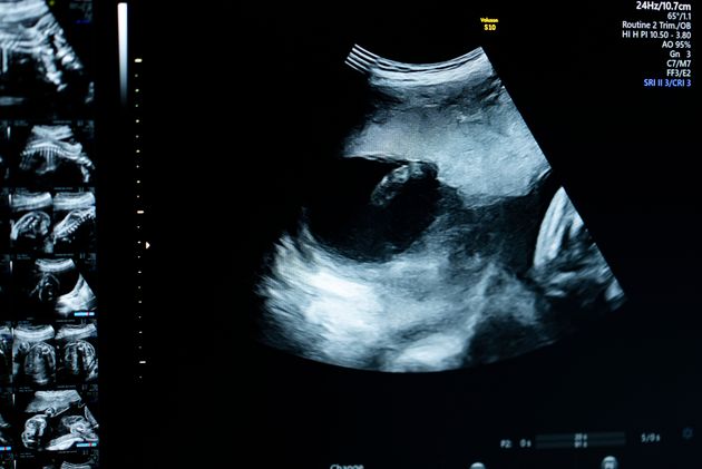 イメージ画像：妊娠22週の超音波画像