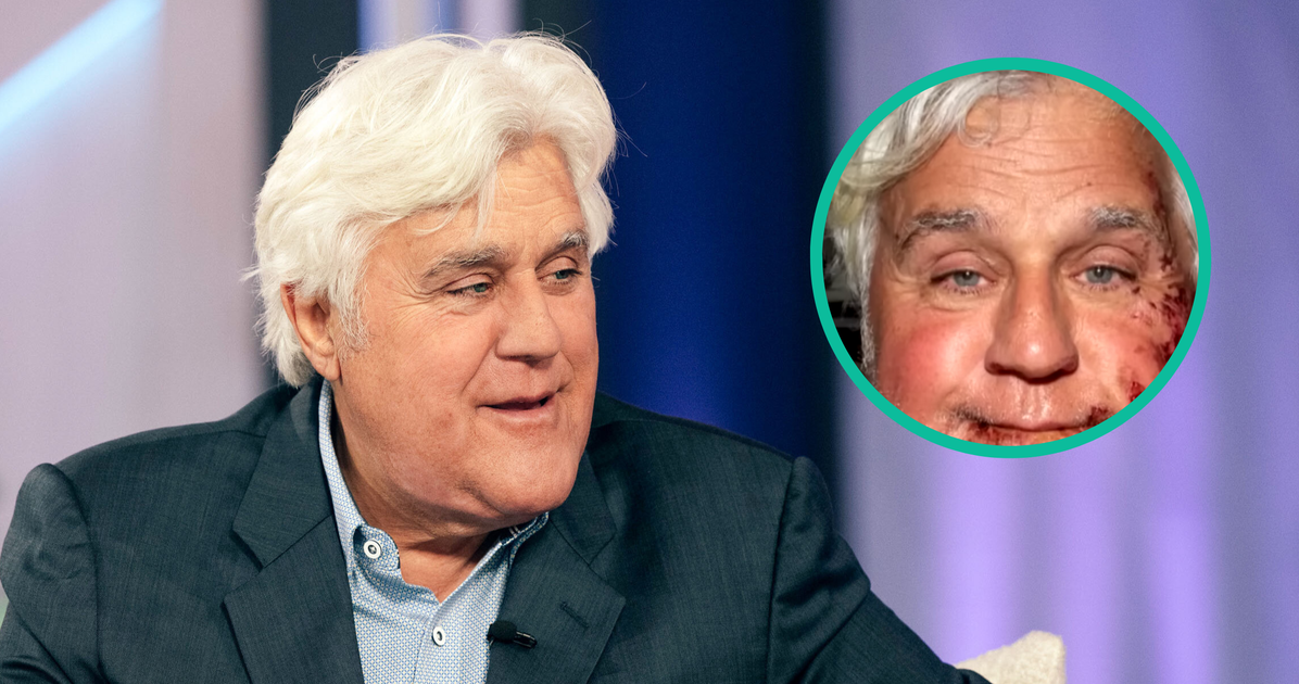 NextImg:Jay Leno Shows Off His 'Brand New Face' After Third-Degree Burn Injuries