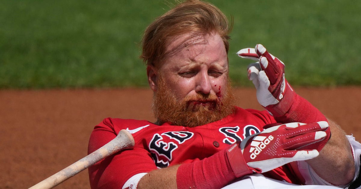 Boston’s Justin Turner Needs 16 Stitches After Pitch Hits Face Boston’s Justin Turner Needs 16 Stitches After Pitch Hits Face