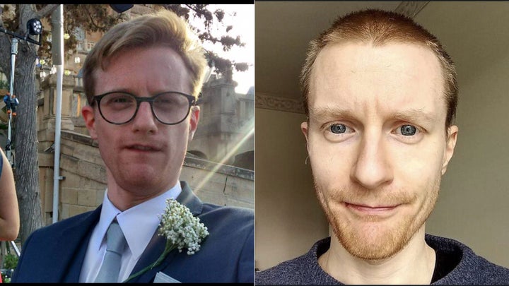 Owen White, pictured here before and after having COVID, said long COVID feels like fighting a "double hangover."