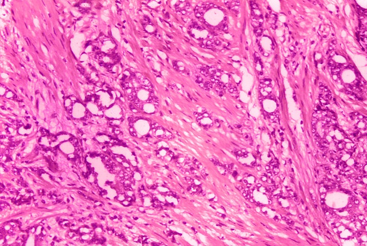 FILE - This 1974 microscope image made available by the Centers for Disease Control and Prevention shows changes in cells indicative of adenocarcinoma of the prostate. A study published by the New England Journal of Medicine on Saturday, March 11, 2023, finds long-term evidence that actively monitoring prostate cancer can be a safe alternative to immediate surgery or radiation. (Dr. Edwin P. Ewing, Jr./CDC via AP)