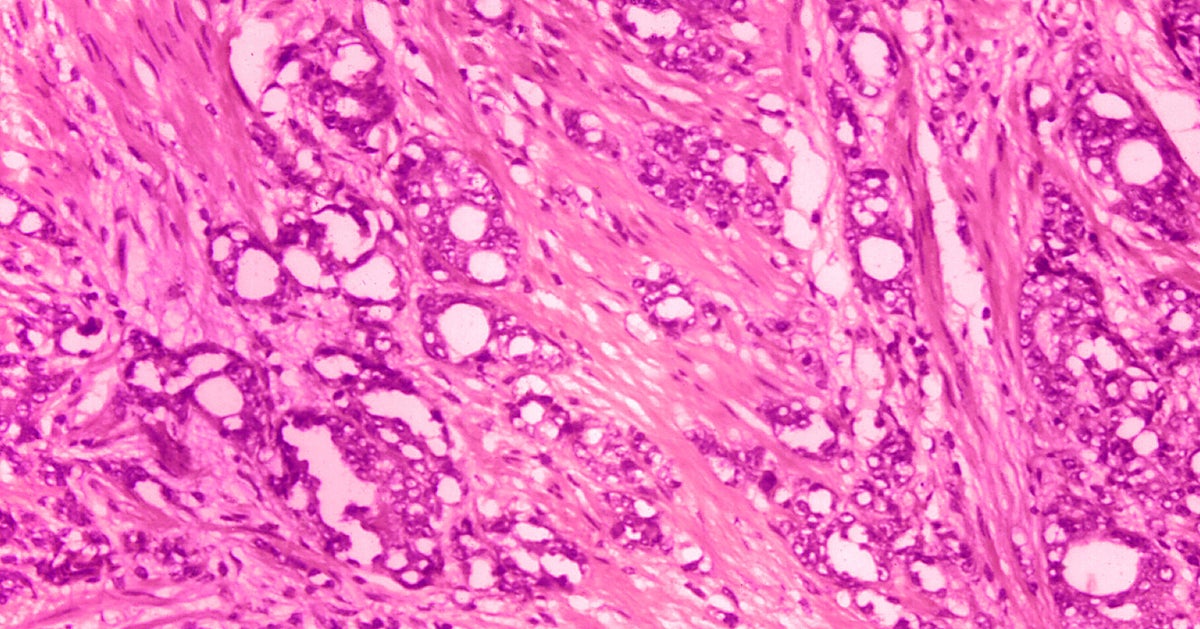 NextImg:Prostate Cancer Treatment Can Wait For Most Men, Study Finds