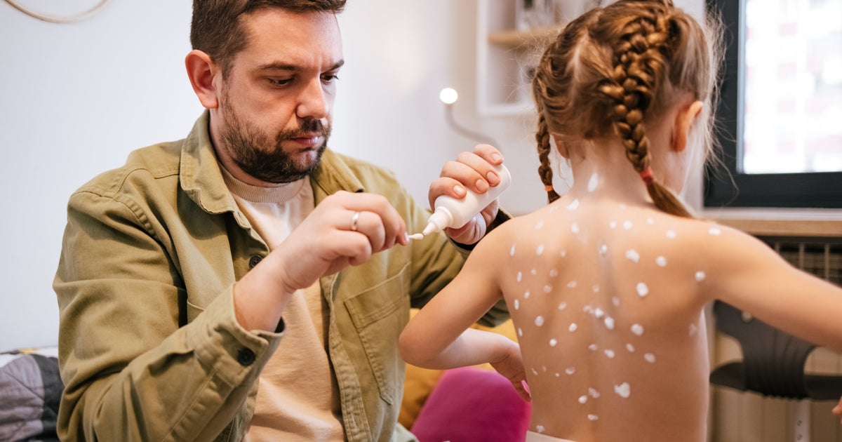 Can A Parent Of A Child With Chickenpox Pass It On? - Vimarsana News