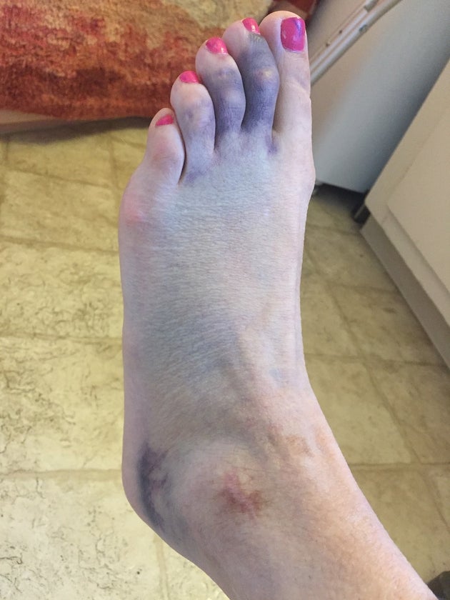 The second ankle shatter that led to the diagnosis in 2018