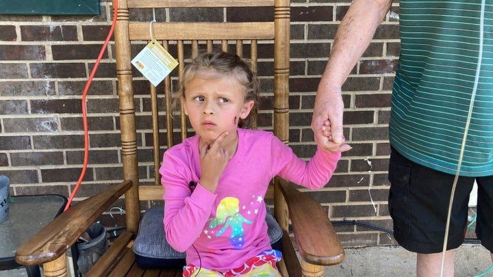 Kinsley White, 6, shows reporters a wound left on her face, on April 20, 2023 in Gastonia, N.C.