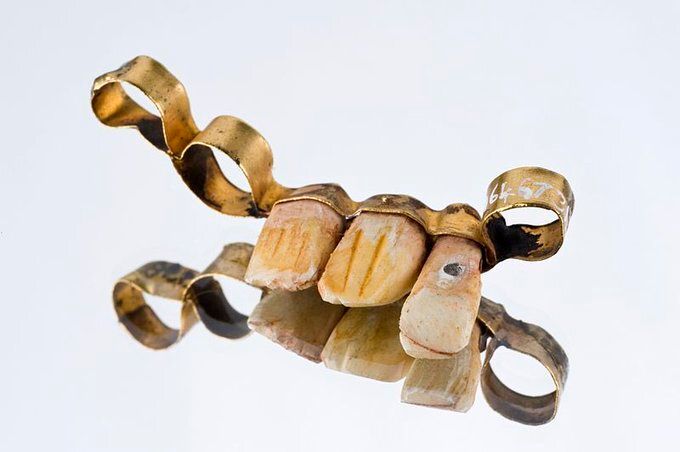 Αντίγραφο μιας ρωμαϊκής οδοντιατρικής γέφυρας που βρέθηκε στο Τεάνο