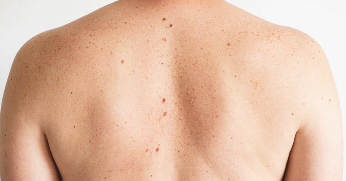 These Are The Five Melanoma Signs Everyone Needs To Know - Vimarsana News