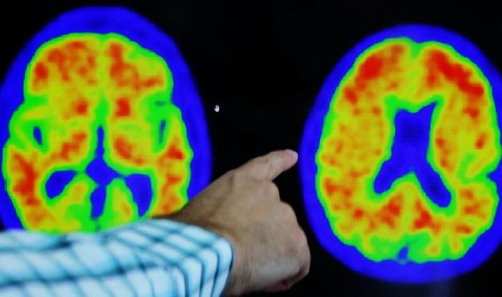 Evidence of Alzheimer’s disease on scans.