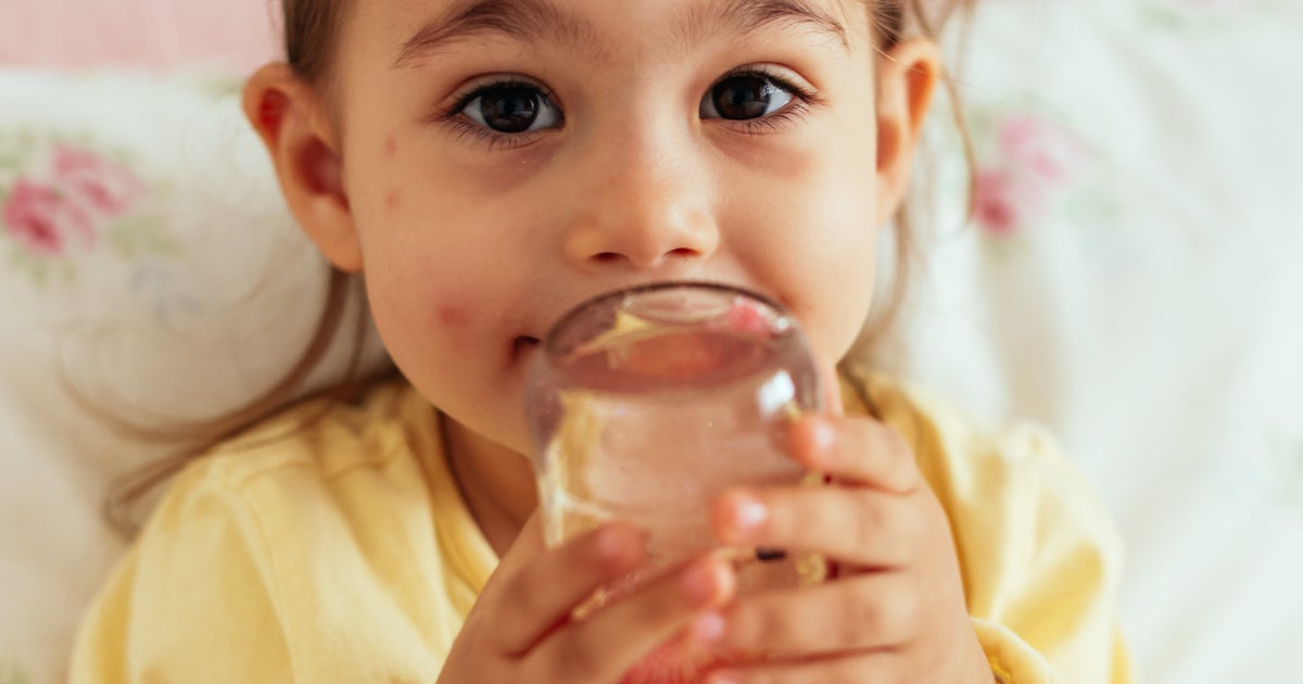 The One Painkiller You Should Never Give To Kids With Chickenpox