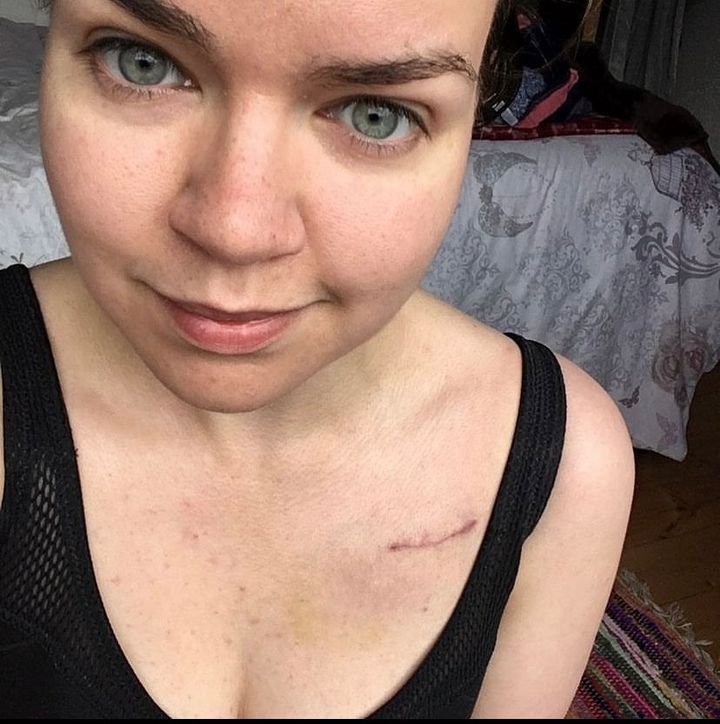 The author two weeks post-op. "After worrying for so long that my heart condition would define me, proudly posting pictures of my recovery made me feel like I had reclaimed the narrative around my own life," she writes.