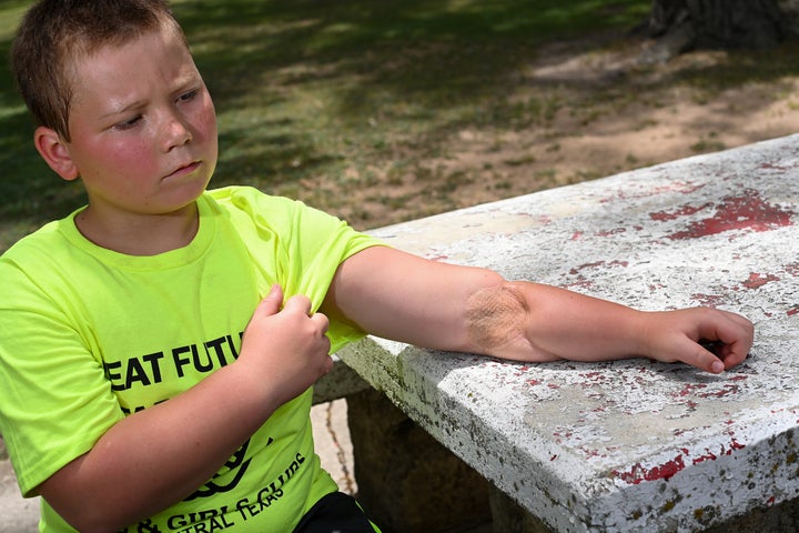 Ryland Ward was 5 years old when he was shot multiple times by a gunman at First Baptist Church in Sutherland Springs. He shows off a gunshot wound to his left arm in 2022. He also has a similar, albeit larger, injury on his left thigh.