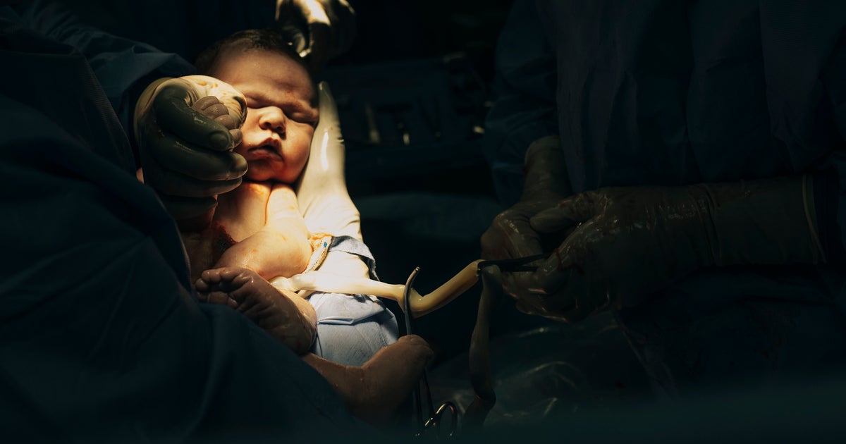 Vaginal Seeding After C-Section – What You Need To Know - Vimarsana News