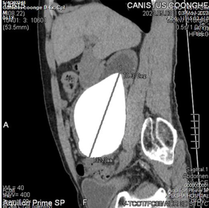 An X-ray of the kidney stone removed from Canistus Coonghe on June 1.