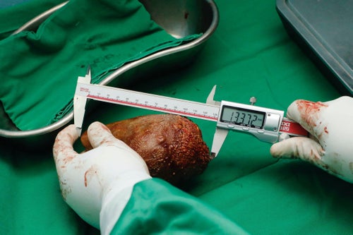 世界最大の腎臓結石」が摘出される。腎臓より大きく野球ボール5個分の