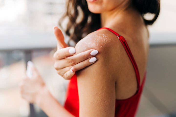 Sunburn Relief: Expert Advice From Dermatologists