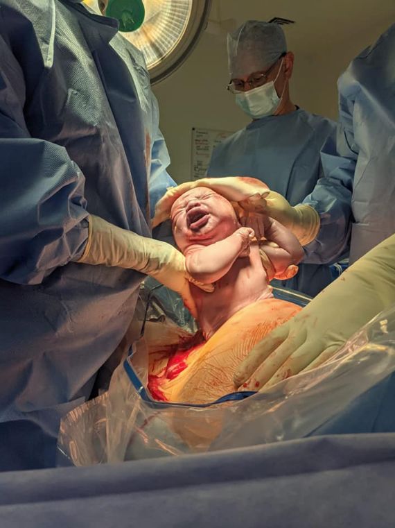 A photo of Jesse being delivered via C-section.