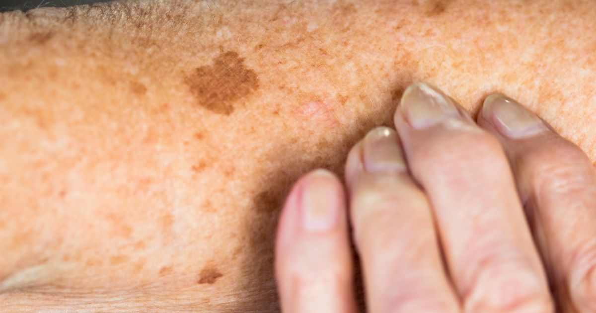 how-to-tell-if-it-s-an-age-spot-or-skin-cancer-huffpost-uk-life