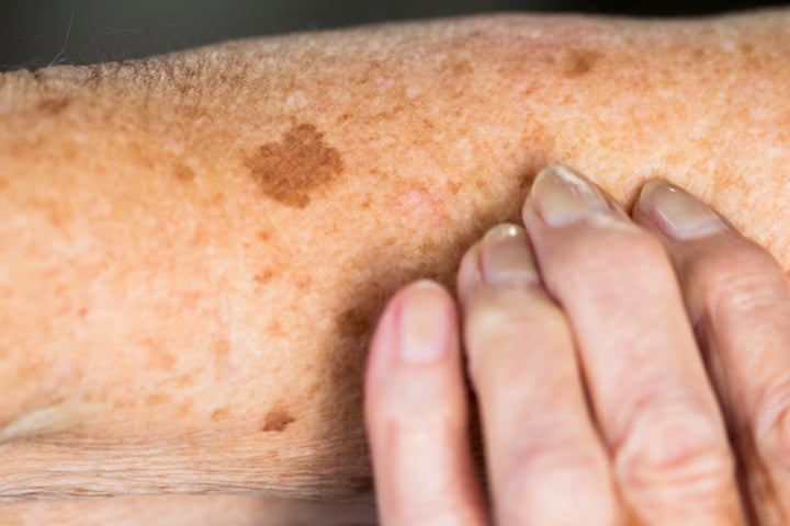 How To Tell If Its An Age Spot Or Skin Cancer Huffpost Uk Life 