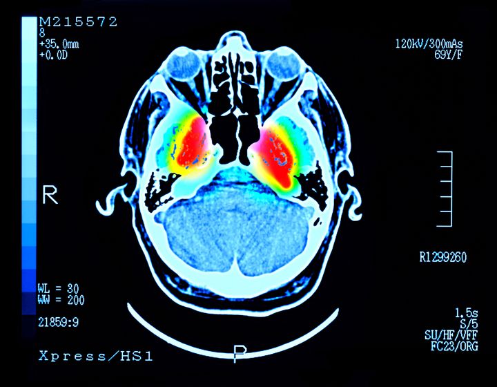 Ακτινογραφία εγκεφάλου ασθενούς.