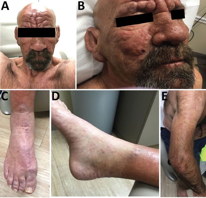 A Florida man who recently developed a painful rash from the disease on his face and body had no known risk factors for it, the CDC said.