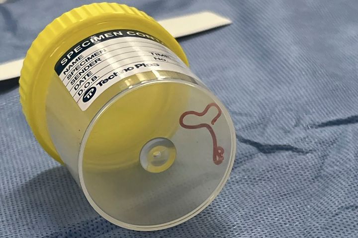 Φωτογραφία που παρέχεται από τις Υπηρεσίες Υγείας της Καμπέρα, δείχνει ένα παράσιτο σε δοχείο δείγματος σε νοσοκομείο της Καμπέρα, στην Αυστραλία.