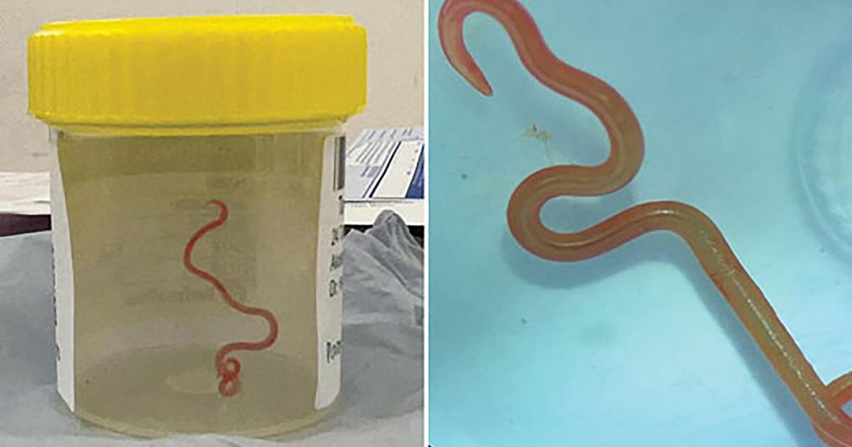 Surgeons Remove Parasitic Worm From Australian Woman's Brain - Vimarsana News