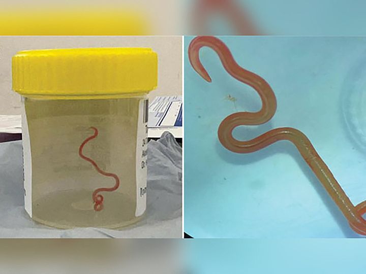 A live roundworm found in a 64-year-old Australian woman's brain. 