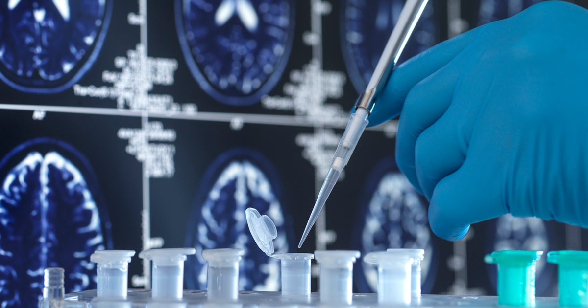 Alzheimer Durchbruch Hirnforschung Mit Lithium Gegen Alzheimer Die Erstaunliche Wahrheit - 2kluksx