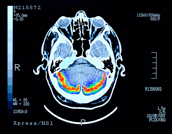 Brain scan shows problems