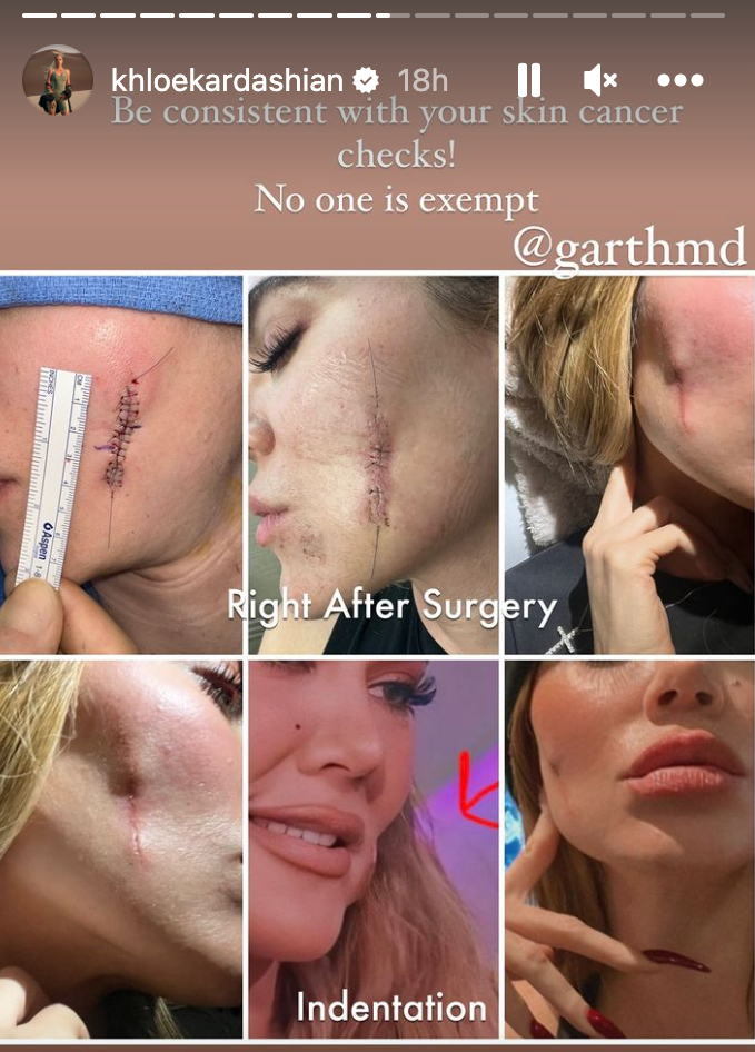 Khloé Kardashian Shares Photos Of 'Huge' Indentation On Cheek