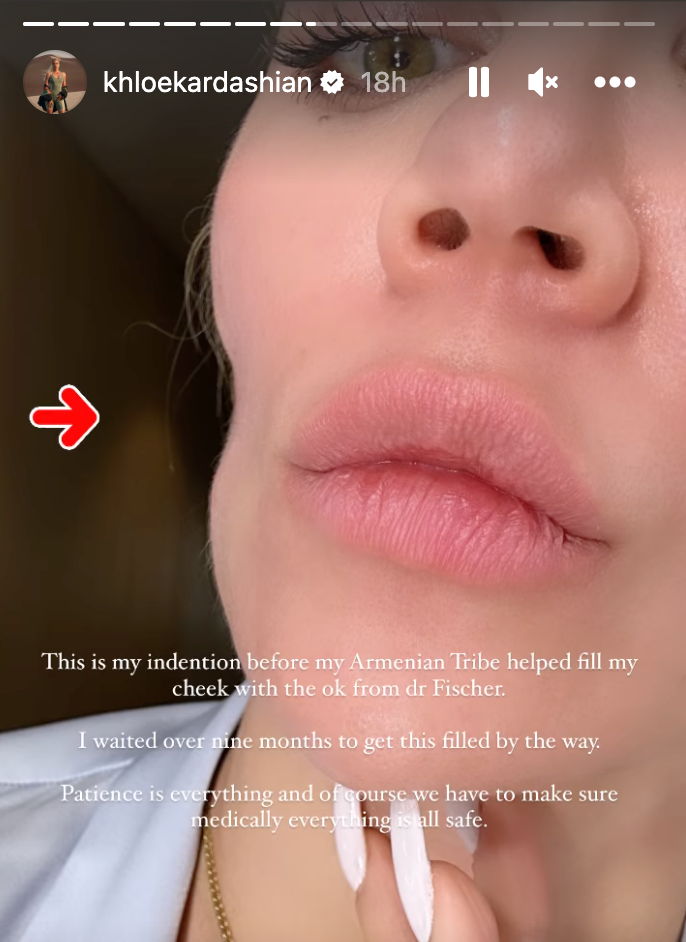 Khloé Kardashian Shares Photos Of 'Huge' Indentation On Cheek