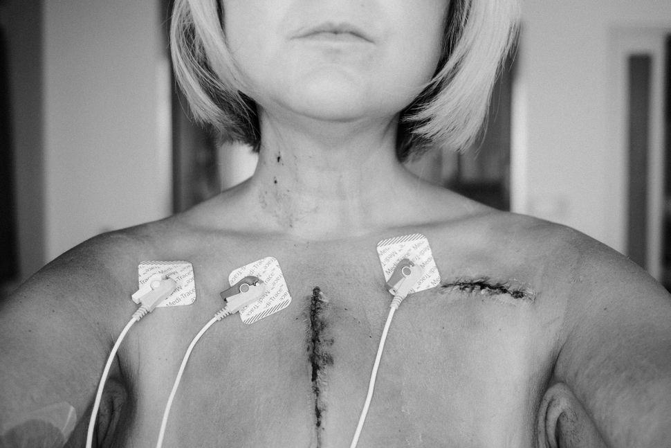 October 29, 2022: I had an implantable cardioverter defibrillator implanted when I was 20 because my mother died suddenly after a deadly arrhythmia. Now, at age 42, they'd removed it.The device had saved my life multiple times. It shocked me back to life in the middle of a visit to my then 11-year-old son’s orthodontist, and another time when Geoff found me lying on the floor after I'd been grabbing clothes from the dryer.I told my team prior to my transplant that they could keep my ICD implanted. It was part of me; it kept me safe. I will never forget what they said: “You won’t need it anymore.”