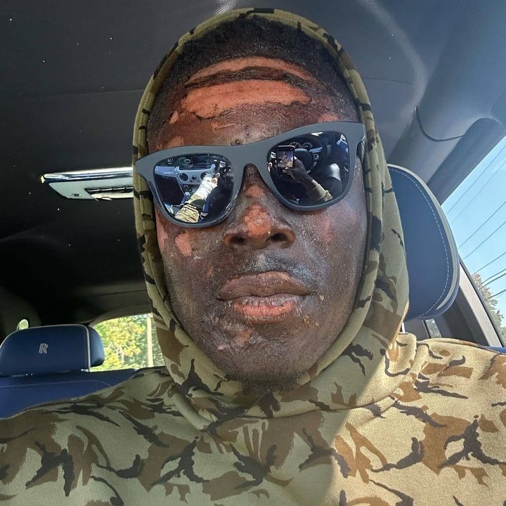 Njoku suffered visible damage to his forehead, cheeks, nose, lips and chin.