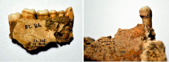 Δείγματα οδοντικής πέτρας που εξήχθησαν και αναλύθηκαν