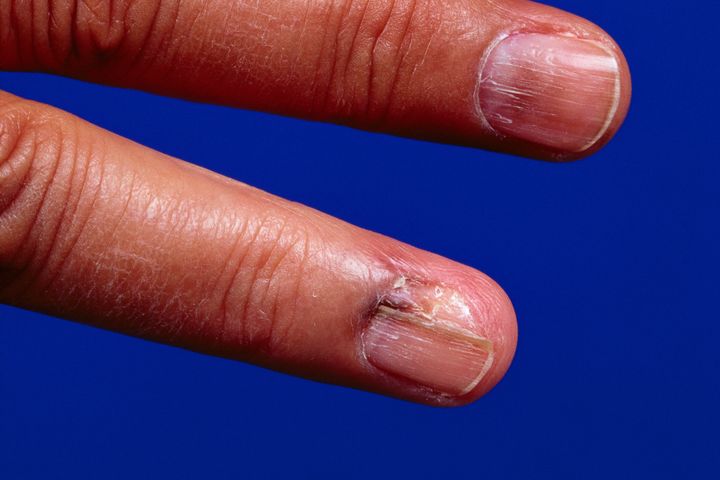 A malignant melanoma is visible via a dark spot under the nail, on the nail bed.