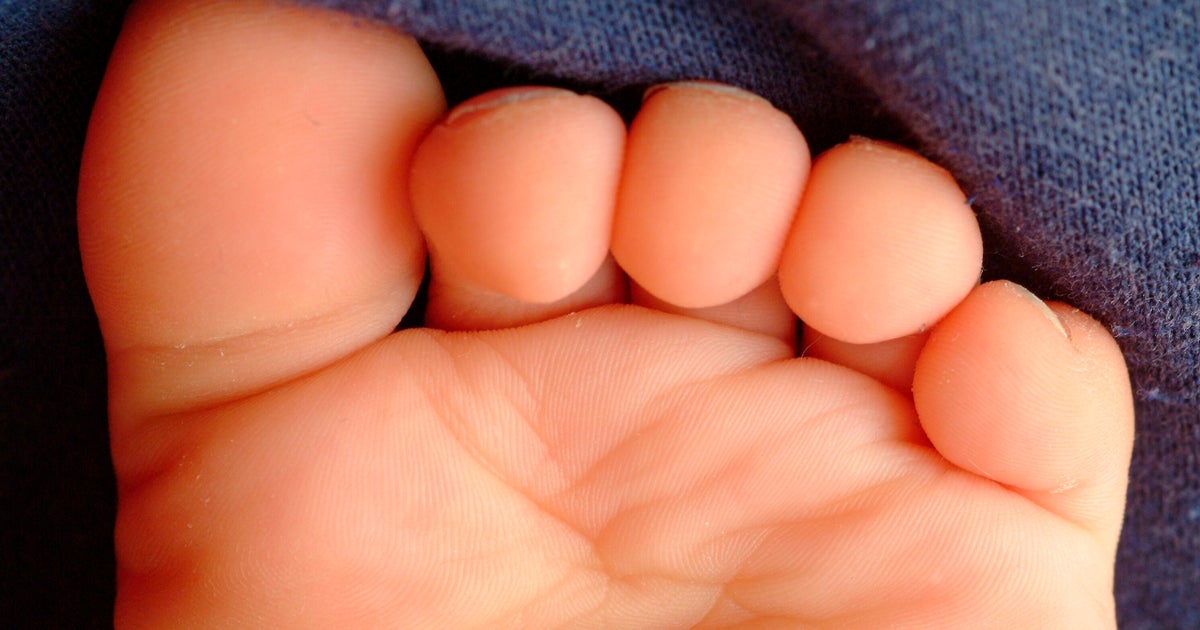 Hair Tourniquet Midwife Shares Warning After Baby's Toe Went Black