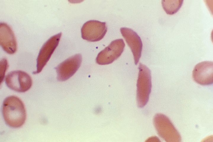 Αυτή η φωτογραφία μικροσκοπίου που παρέχεται από τα Κέντρα Ελέγχου και Πρόληψης Νοσημάτων δείχνει ερυθρά αιμοσφαίρια σε σχήμα ημισελήνου από ασθενή με δρεπανοκυτταρική νόσο το 1972. Η διαταραχή επηρεάζει την αιμοσφαιρίνη, την πρωτεΐνη στα ερυθρά αιμοσφαίρια που μεταφέρει οξυγόνο. Μια γενετική μετάλλαξη προκαλεί τα κύτταρα να αποκτήσουν σχήμα μισοφέγγαρου, το οποίο μπορεί να εμποδίσει τη ροή του αίματος και να προκαλέσει αφόρητο πόνο, βλάβη οργάνων, εγκεφαλικό επεισόδιο και άλλα προβλήματα.