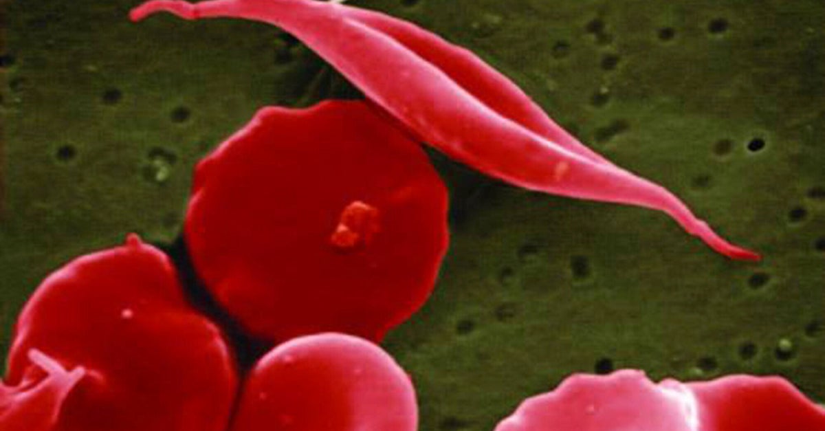 NextImg:Breakthrough Gene Treatments For Sickle Cell Disease Approved