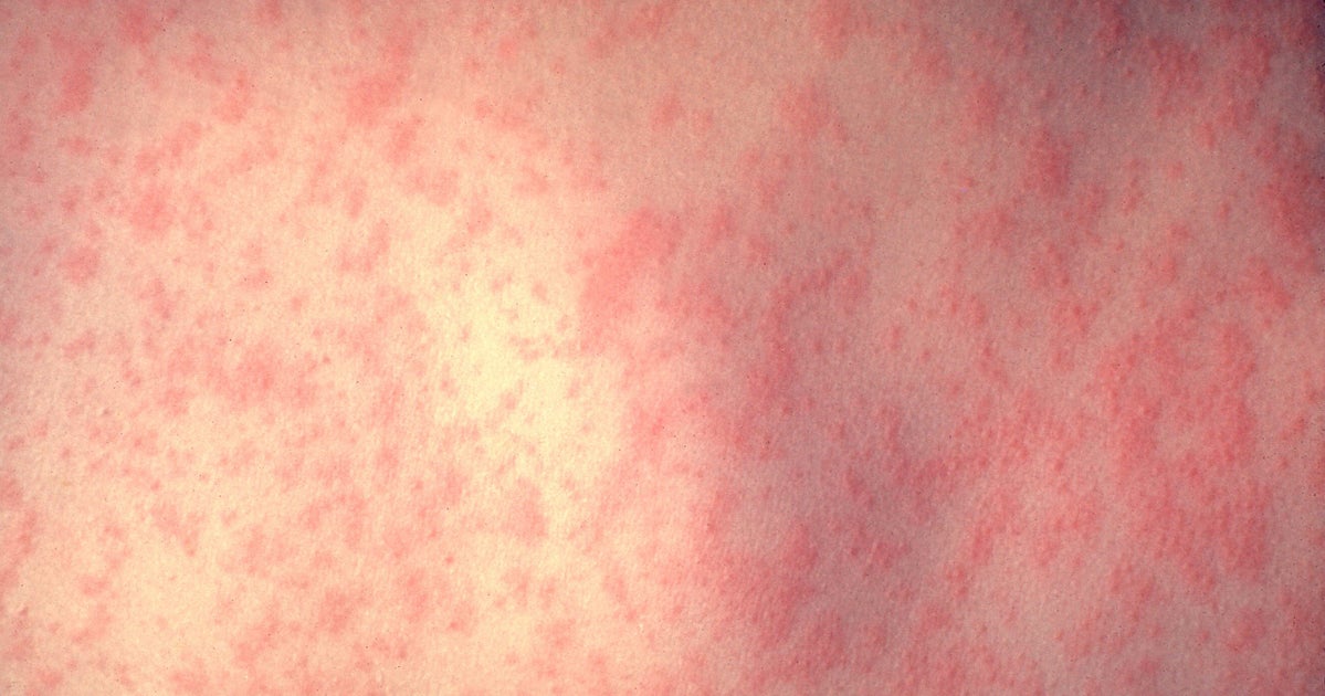 Philadelphia Warns Of Measles Outbreak After Quarantined Kid Sent To Day Care Anyway  HuffPost Philadelphia Warns Of Measles Outbreak After Quarantined Kid Sent To Day Care Anyway  HuffPost