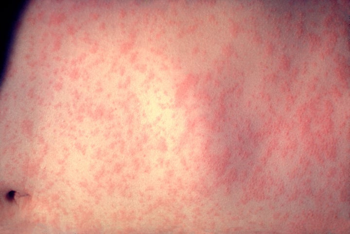 The skin of a patient after three days of measles infection is seen at a New York hospital.