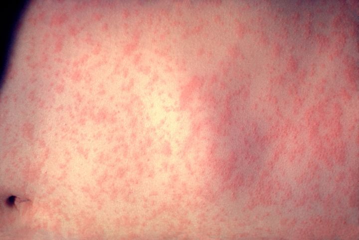 The skin of a patient after three days of measles infection is seen at a New York hospital.