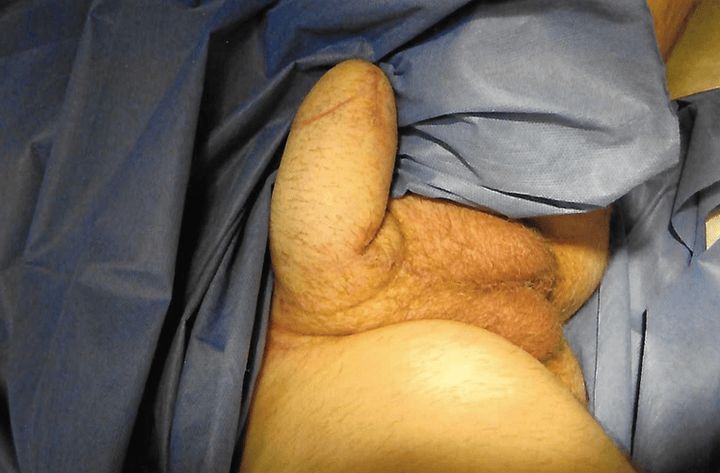 Phalloplasty is a surgical procedure that constructs a realistic-looking penis, like the one above. Patients can opt to have their penis appear circumcised or uncircumcised. After final healing, phalloplasty incisions are nearly undetectable.