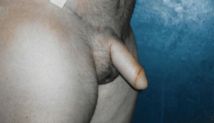 The penis is constructed using skin flaps from the abdomen, groin or thigh. The scrotoplasty procedure uses labial tissues to construct a scrotum. After a phalloplasty, patients experience an orgasm through stimulation of the clitoris, which can remain in its original location or be buried under the skin between the scrotum and the base of the penis.