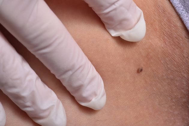 Doctor examining patient's mole on leg cancer skin prevention